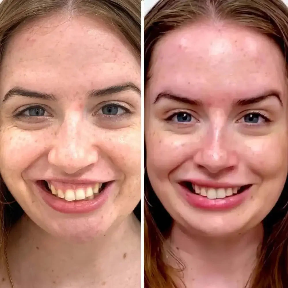 LipFix: Gummy Smile
